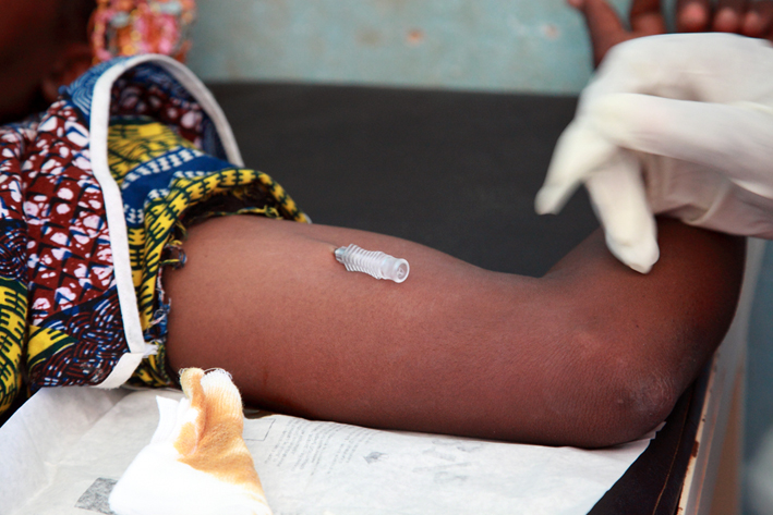 Pose d’un implant contraceptif Jadelle